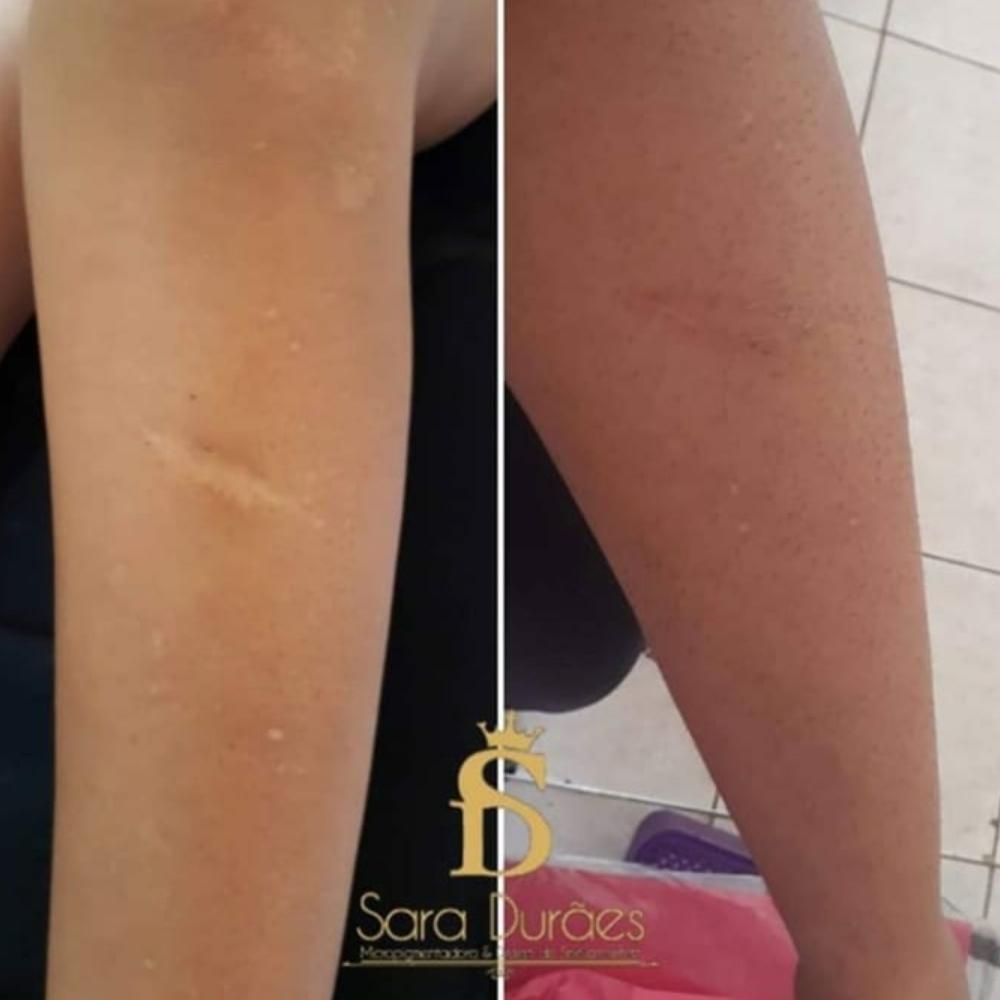Camuflagem de cicatriz em geral