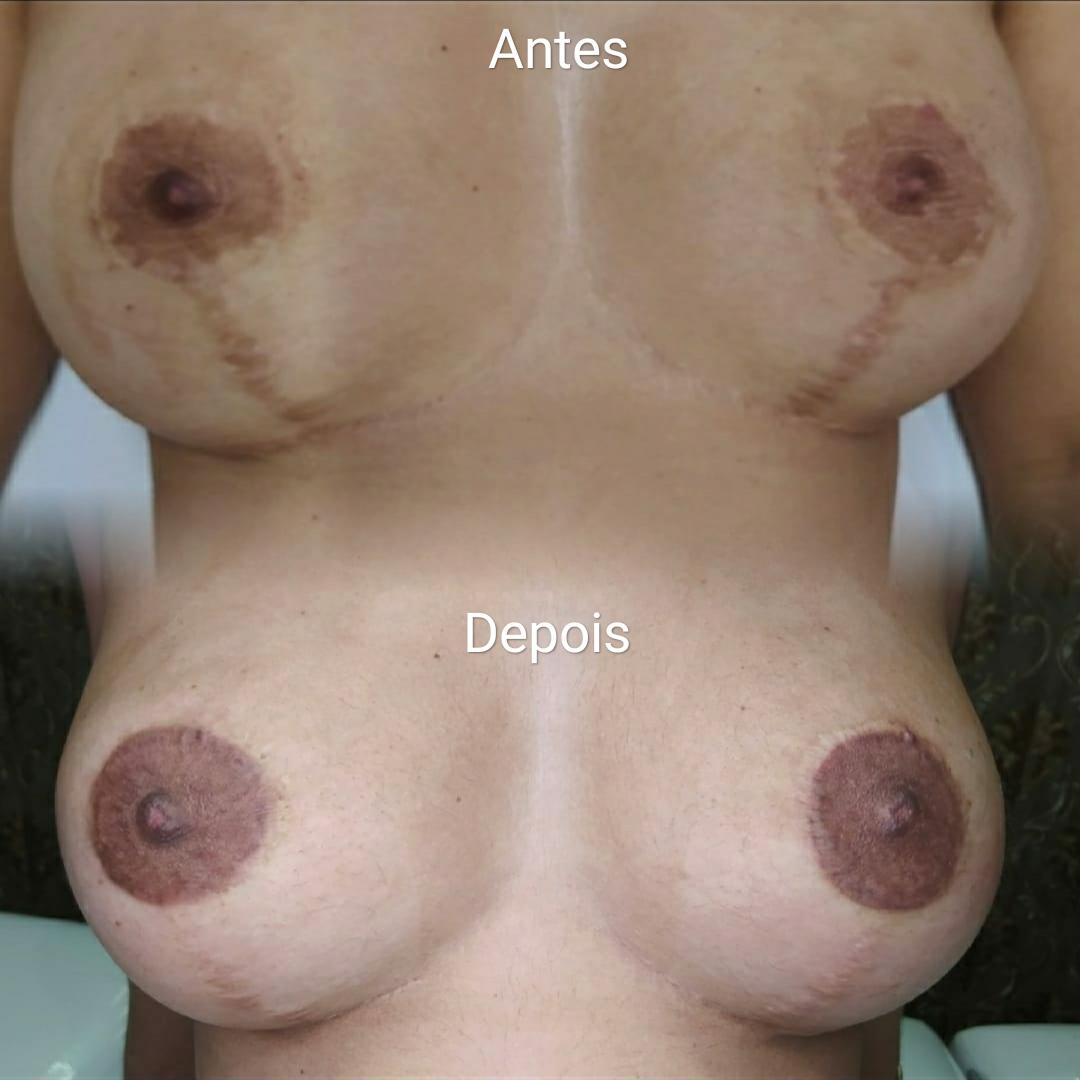Camuflagem de cicatriz em aréola mamária