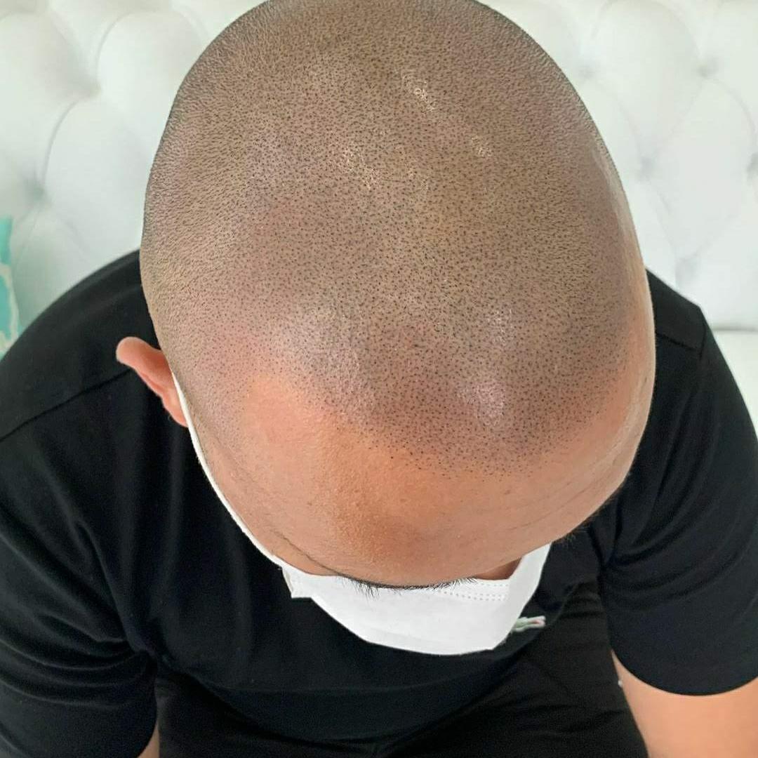 Micropigmentação Capilar