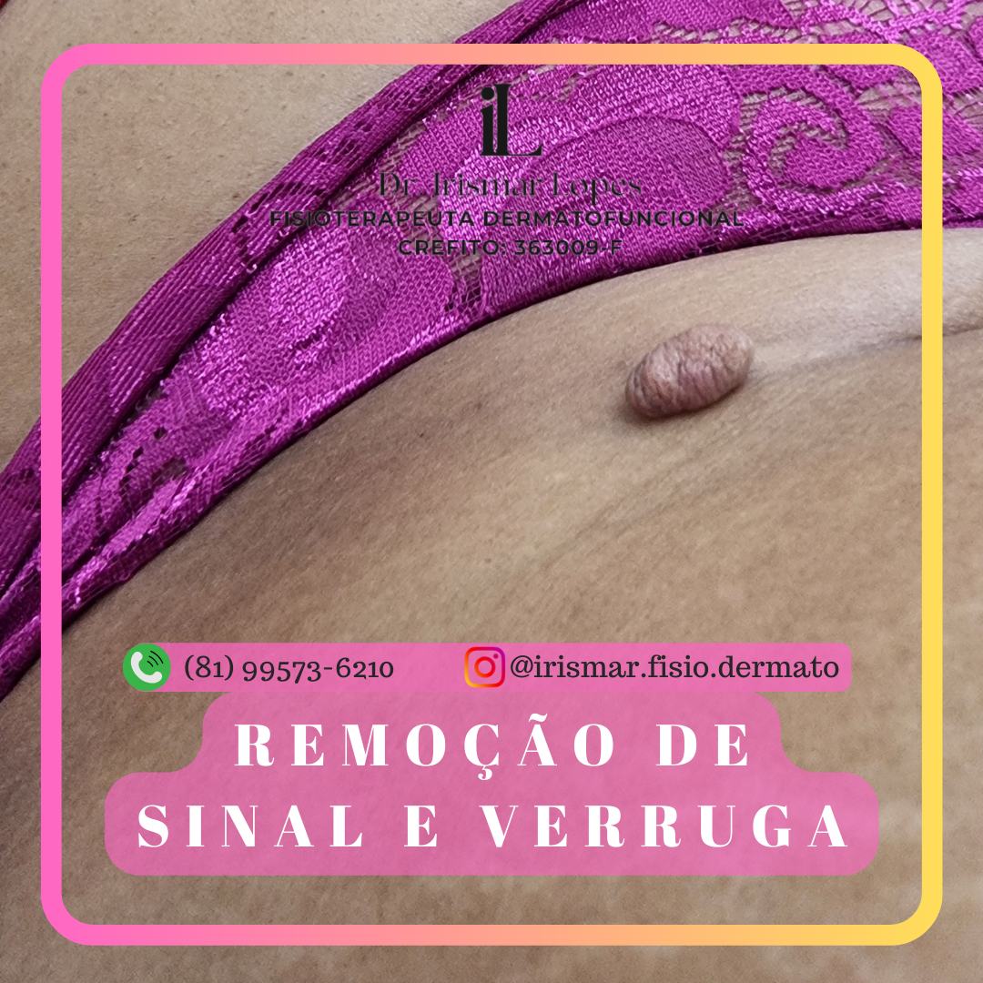 Remoção de Sinal ou Verruga - UND