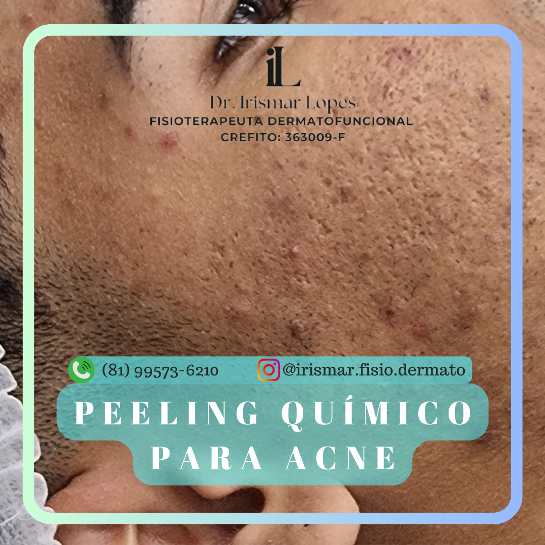 Peeling Químico- Cravos e Espinhas