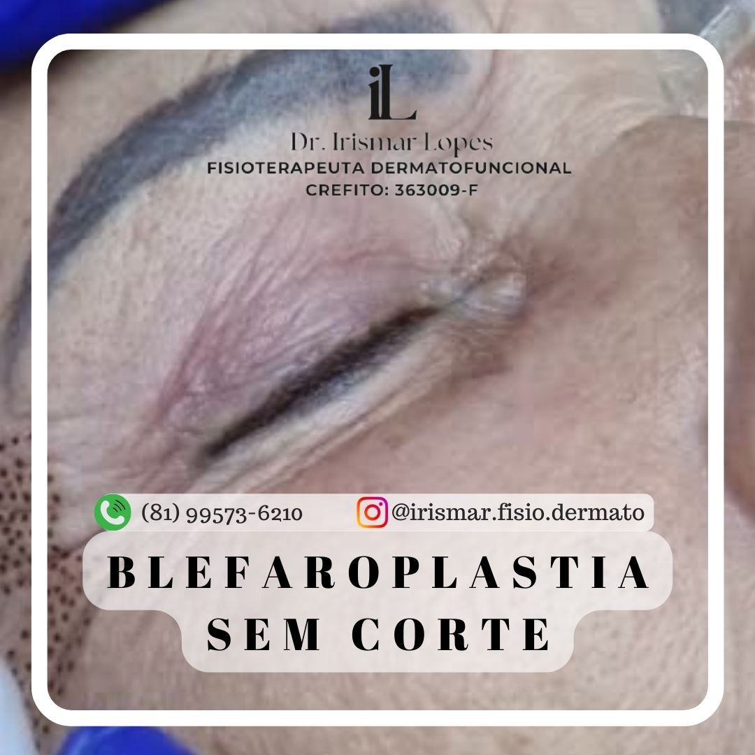 Blefaroplastia sem corte P. Superior + pé de galinha