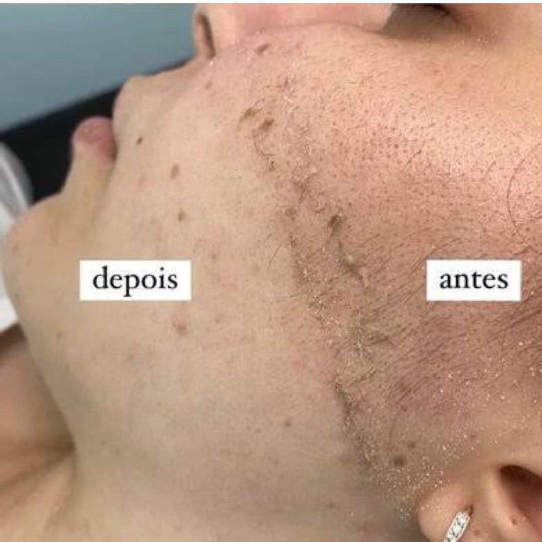 limpeza de pele com Dermaplanig