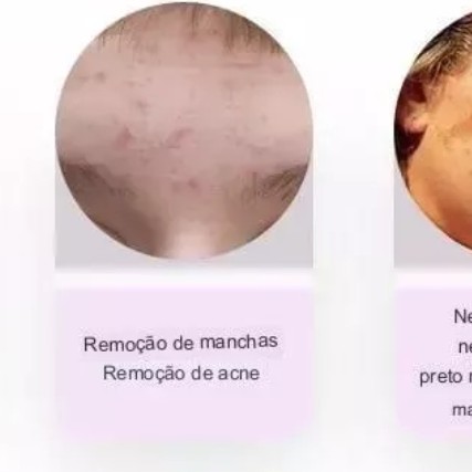 remoção de manchas de Acne a laser