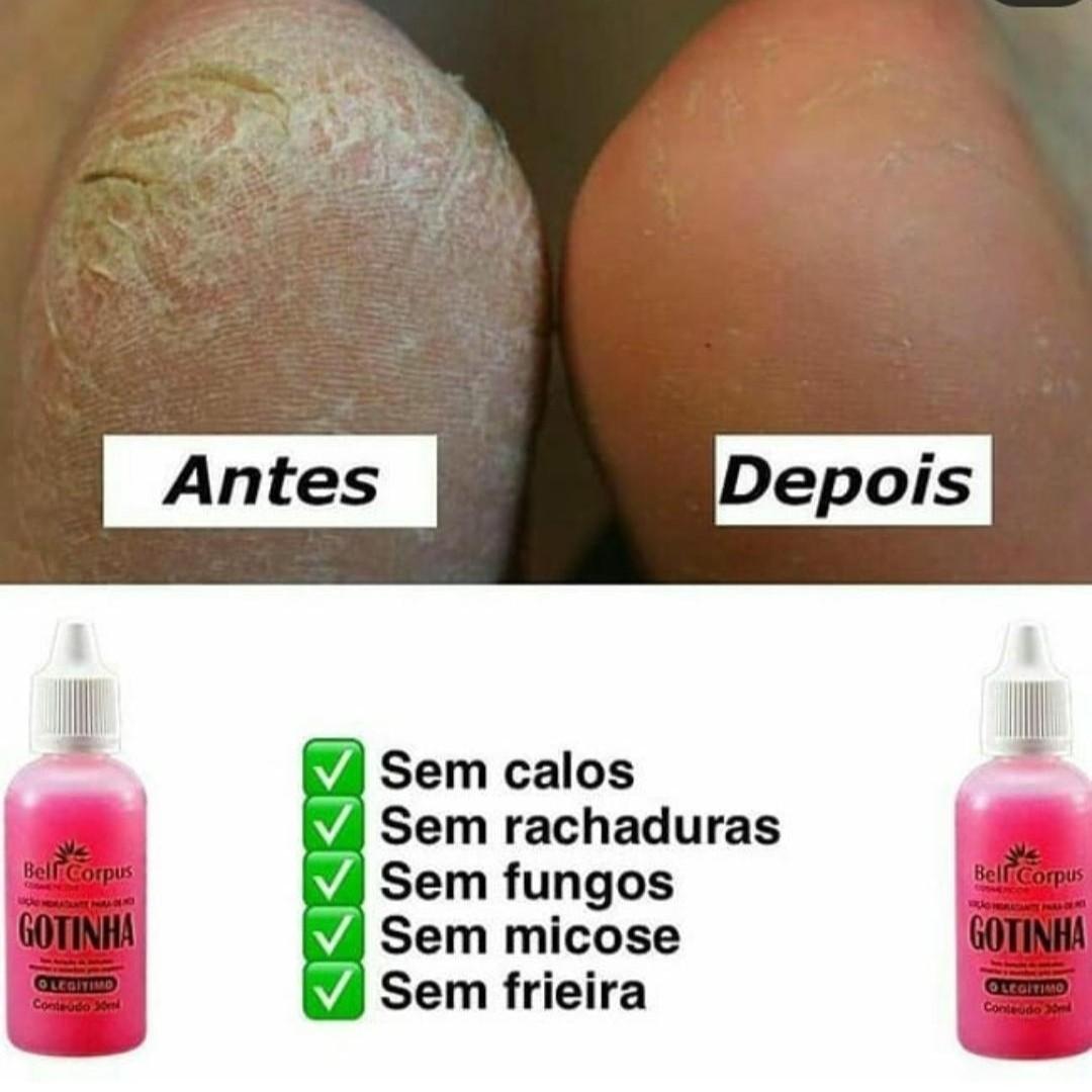 gotinha para rachadura, gungos, micose,sem calos