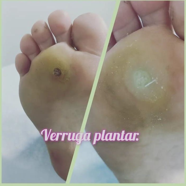 verruga plantar