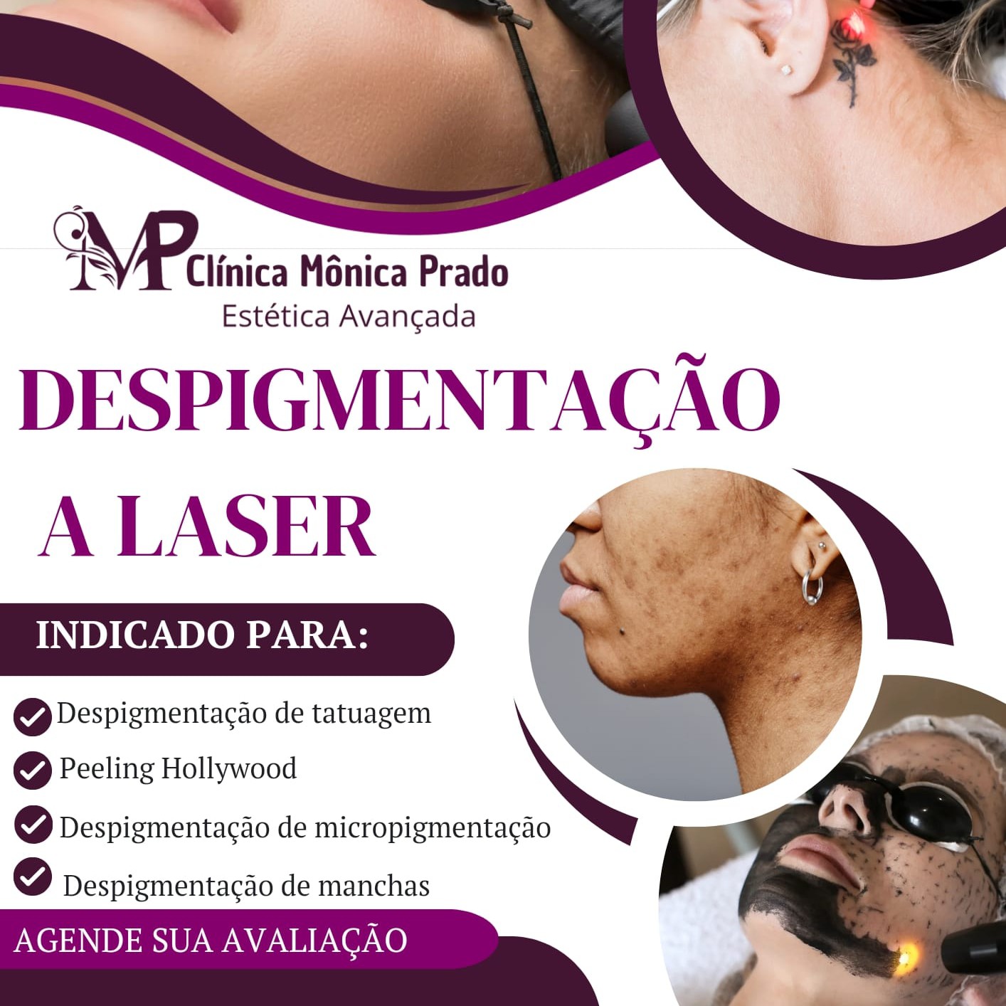 Despigmentação a laser