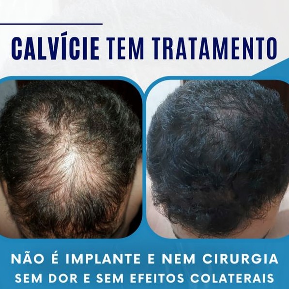 Tratamento para desenvolvimento e crescimento capilar