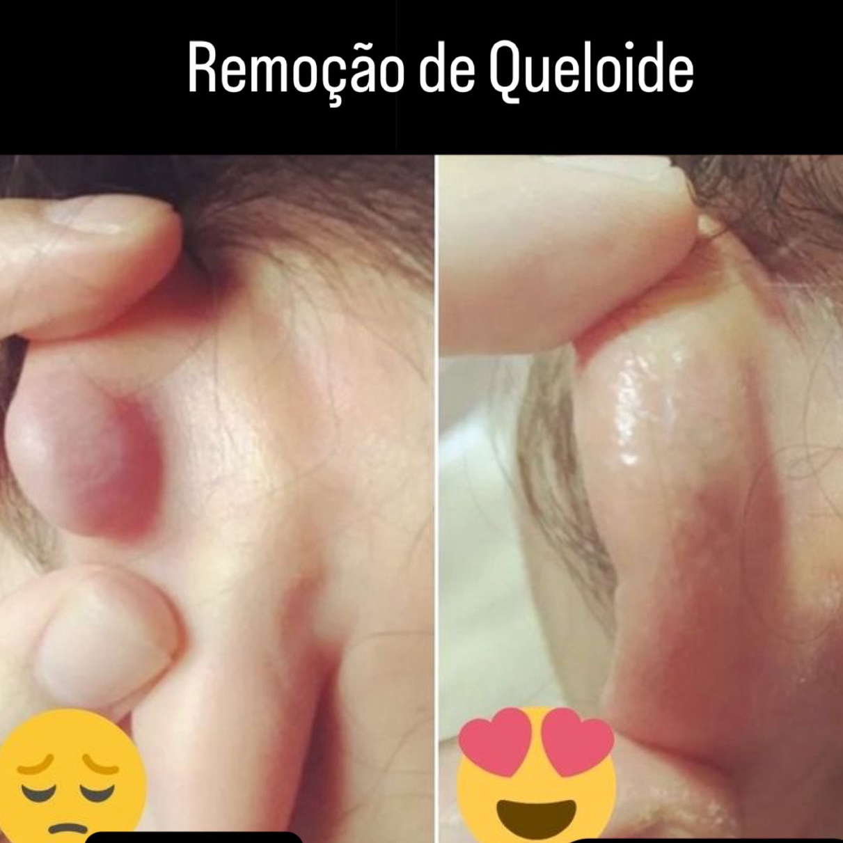 Remoção de Queloide