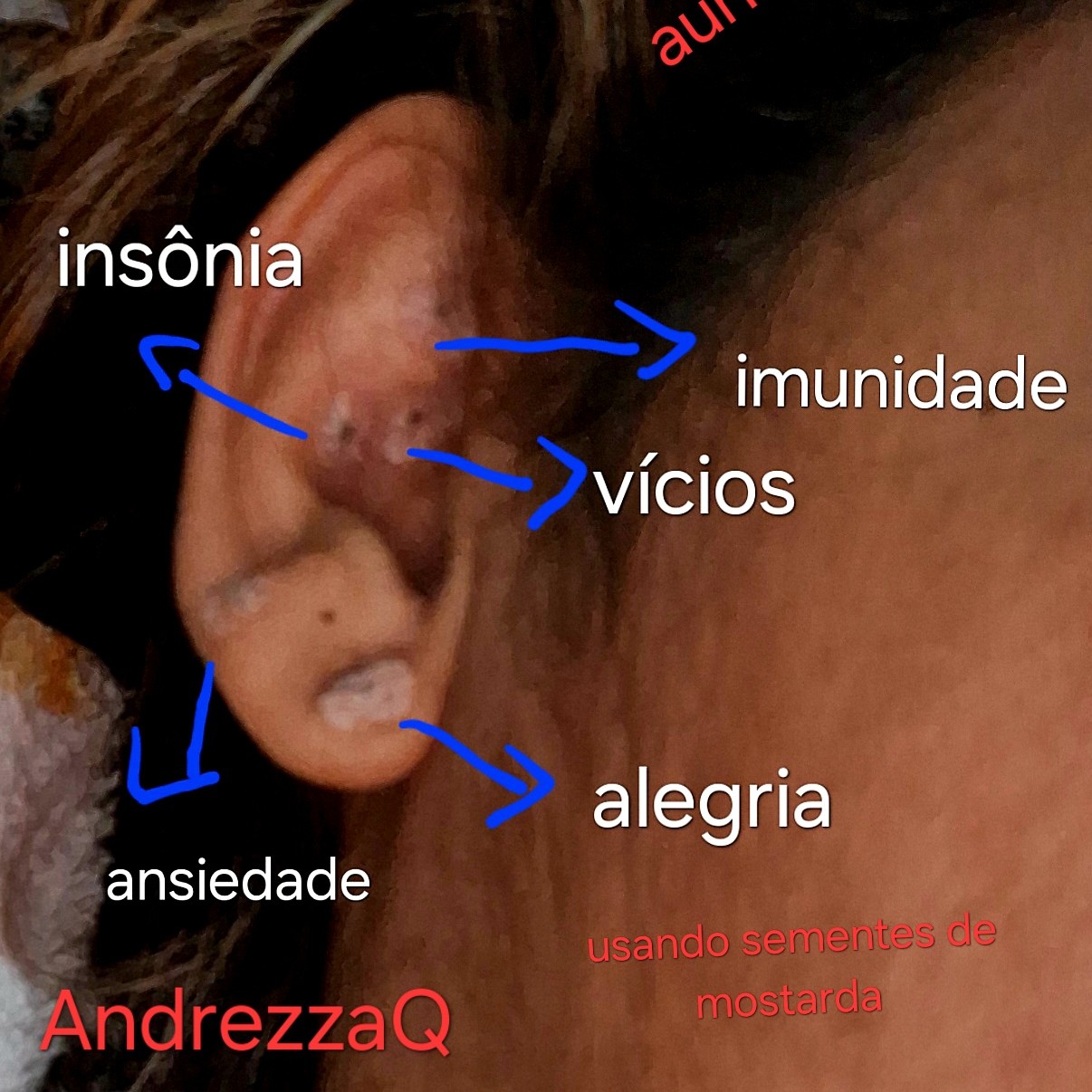 auriculoterapia 4 sessões