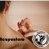 Acupuntura