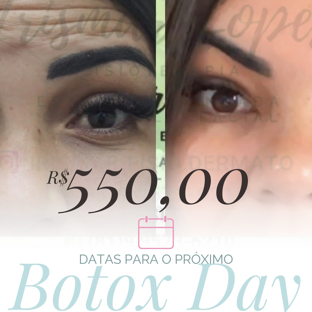 BOTOX - DAY