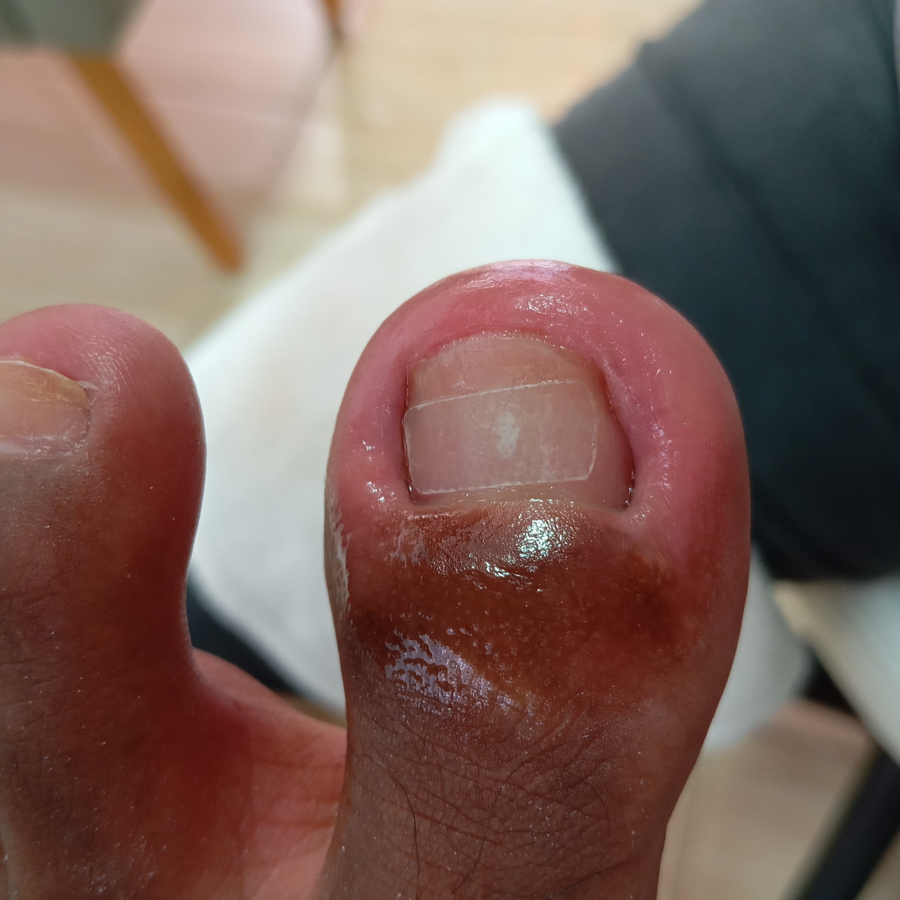 Podoprofilaxia ( limpeza plantar,corte correto das unhas,lixamento ungueal,tratamento de unha encravada,ou com fungos/ micose)