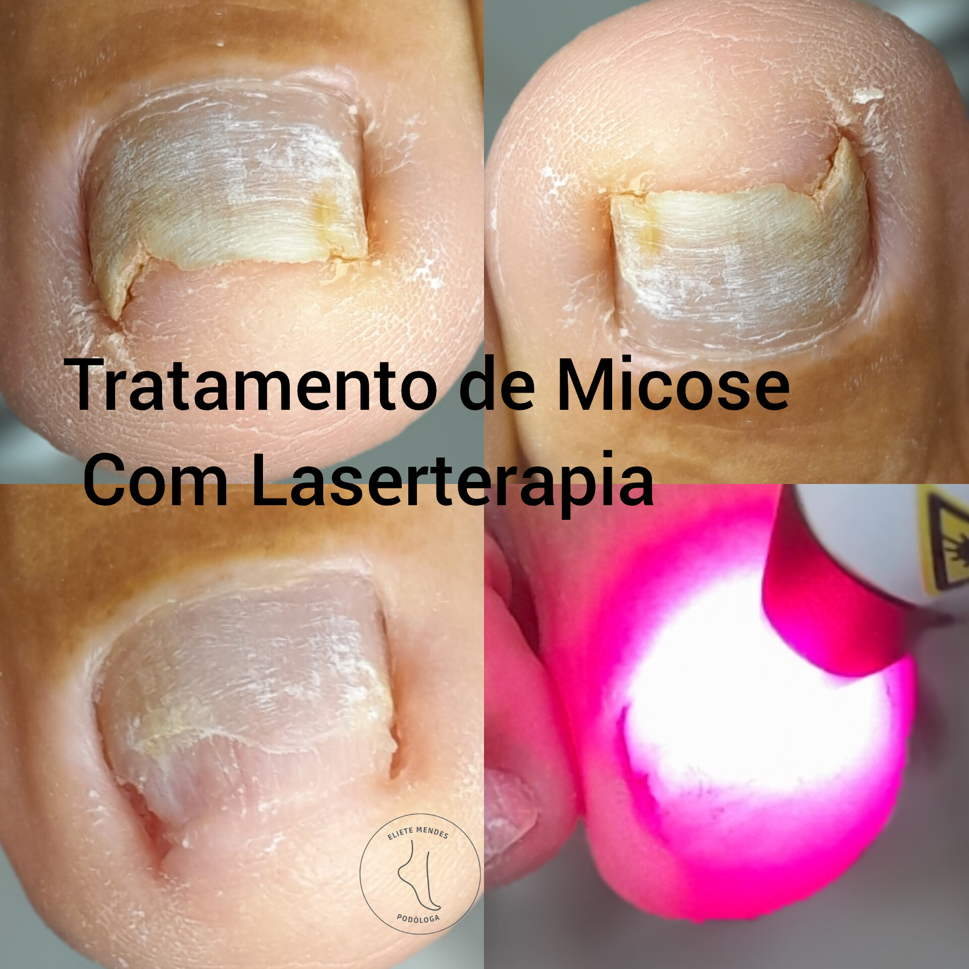 Micose