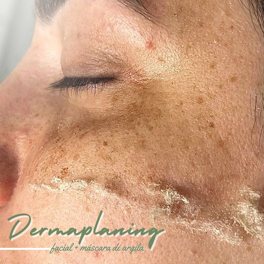 Dermaplaning