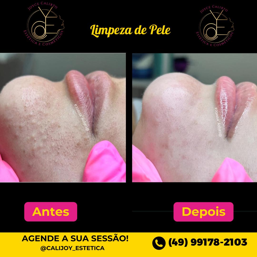 Limpeza de Pele Profunda: Higienização, esfoliação, extração de acne e miliuns, hidratação personalizada, spa dos lábios e alta frequência para uma pele limpa, renovada e radiante.