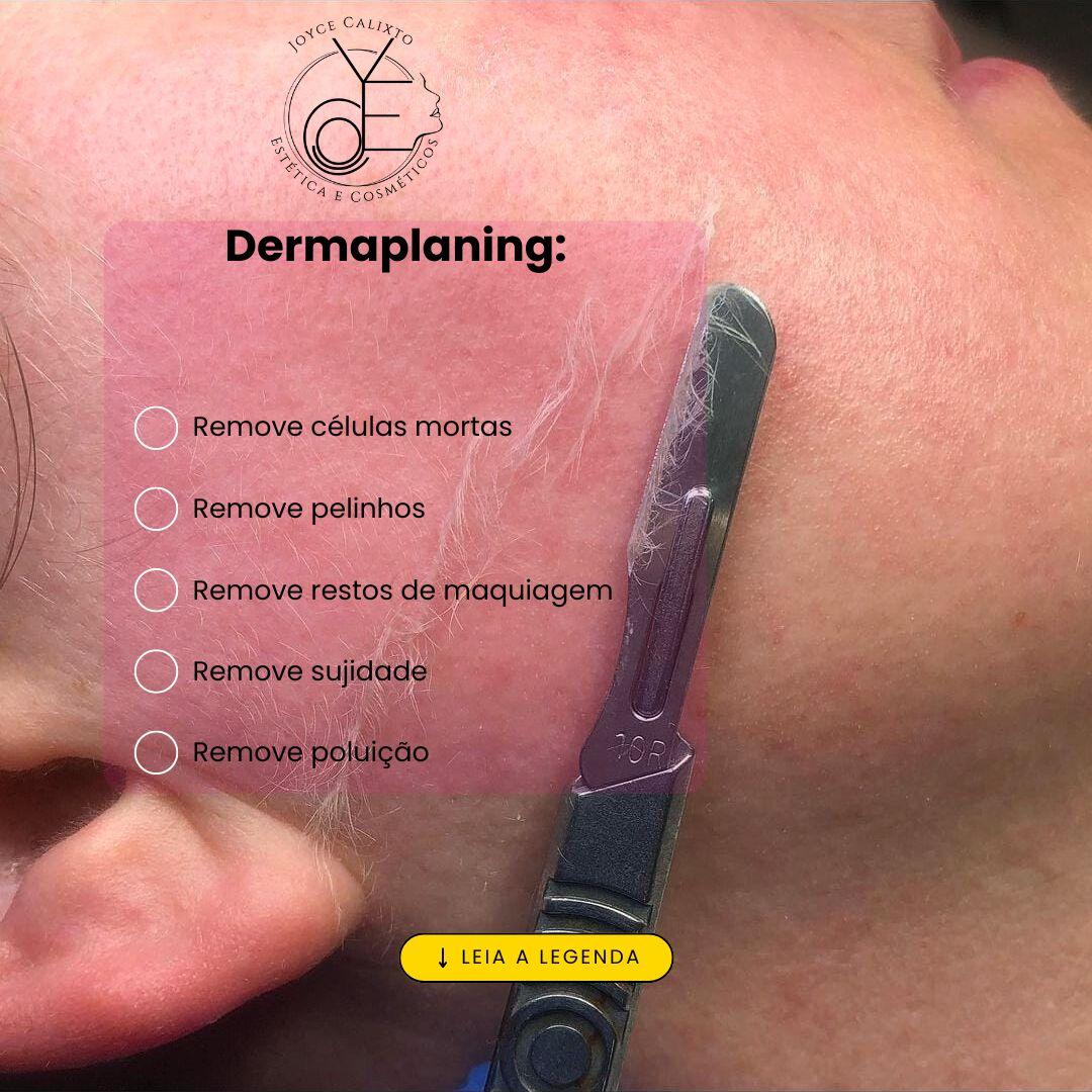 Dermaplaning:  Procedimento realizado com bisturi cirúrgico para a remoção de células mortas, esfoliação física, eliminação de impurezas, penugem e resíduos de maquiagem, deixando a pele mais suave, luminosa e uniforme. Com EFEITO PORCELANA.