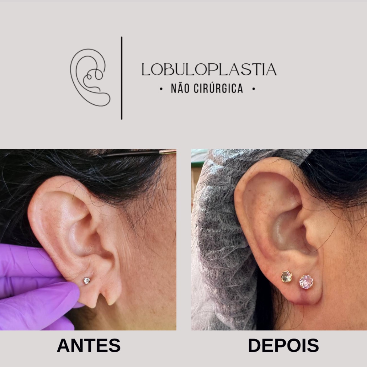 Lobuloplastia - Primeira sessão