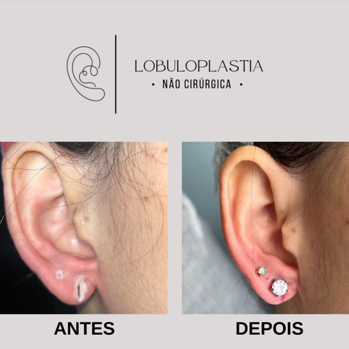 Lobuloplastia - Segunda e terceira sessão