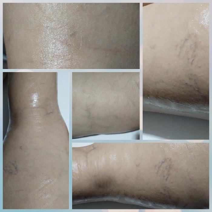 tratamento de varizes celulite