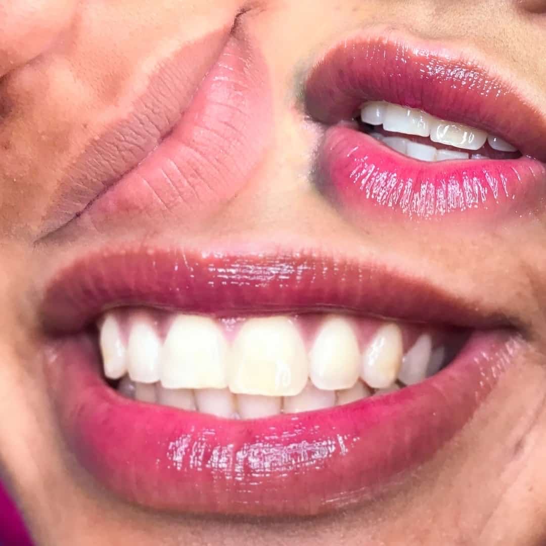 revitalização labial