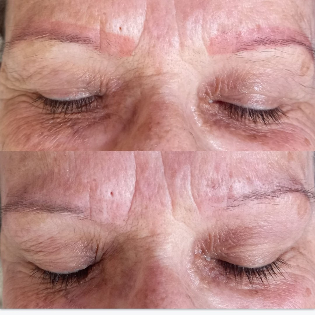 Despigmentação de sobrancelhas (química) - sessão