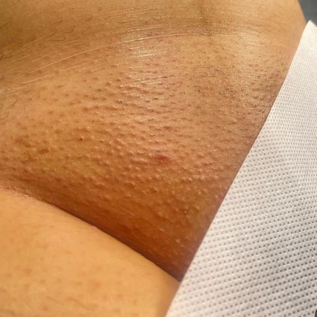 depilação íntima completa