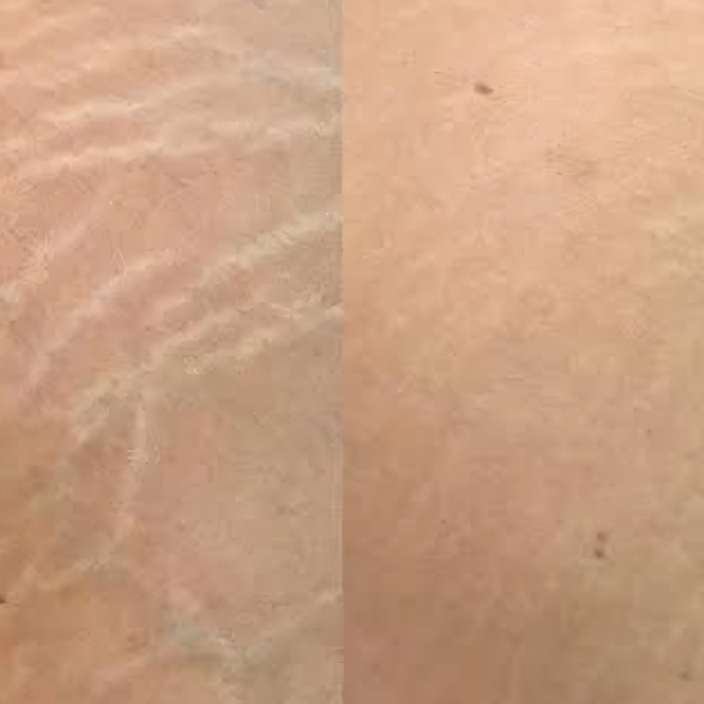 microagulhamento estrias