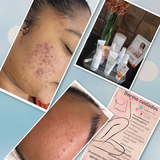 tratamento de acne fácil / um tratamento mensal