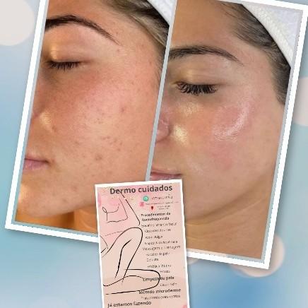 limpeza d pele com extração e máscara