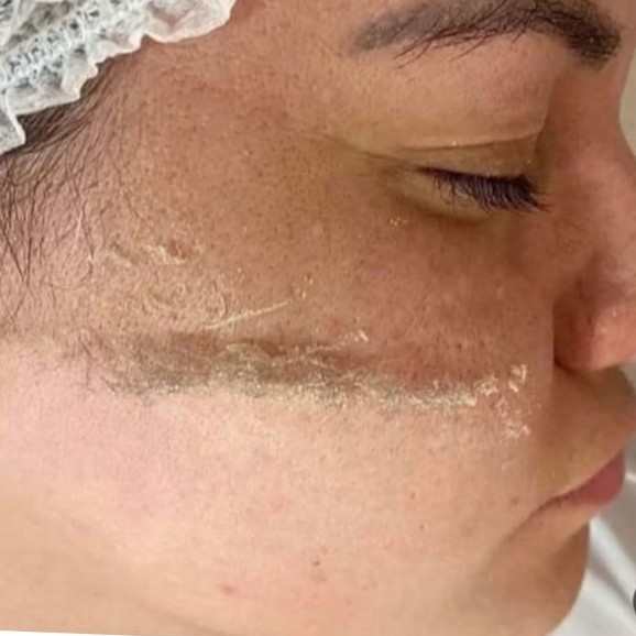 dermaplaning