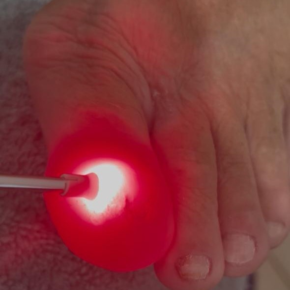 Lazerterapia