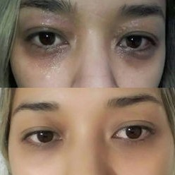 Clareamento de Olheiras