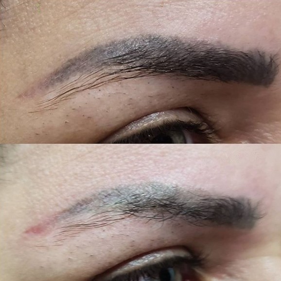 Remoção de Micropigmentação de Sobrancelhas