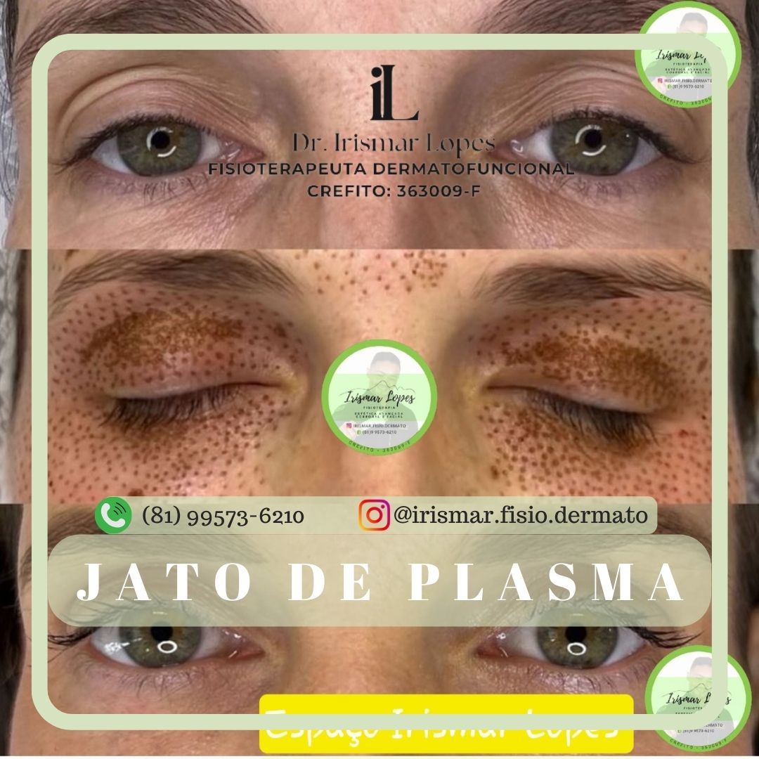 Jato de plasma - Full face