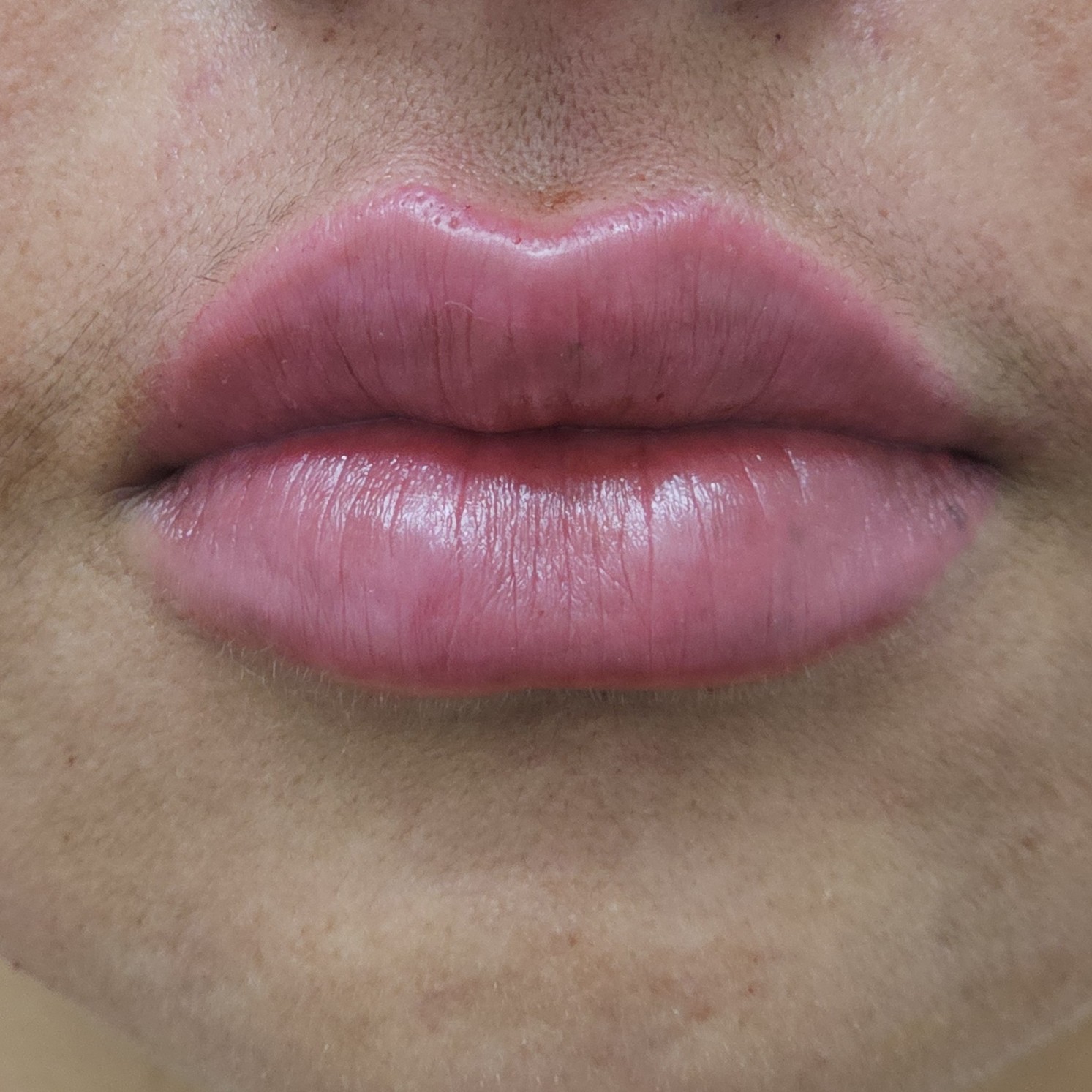 Preenchimento Labial - 1ml
