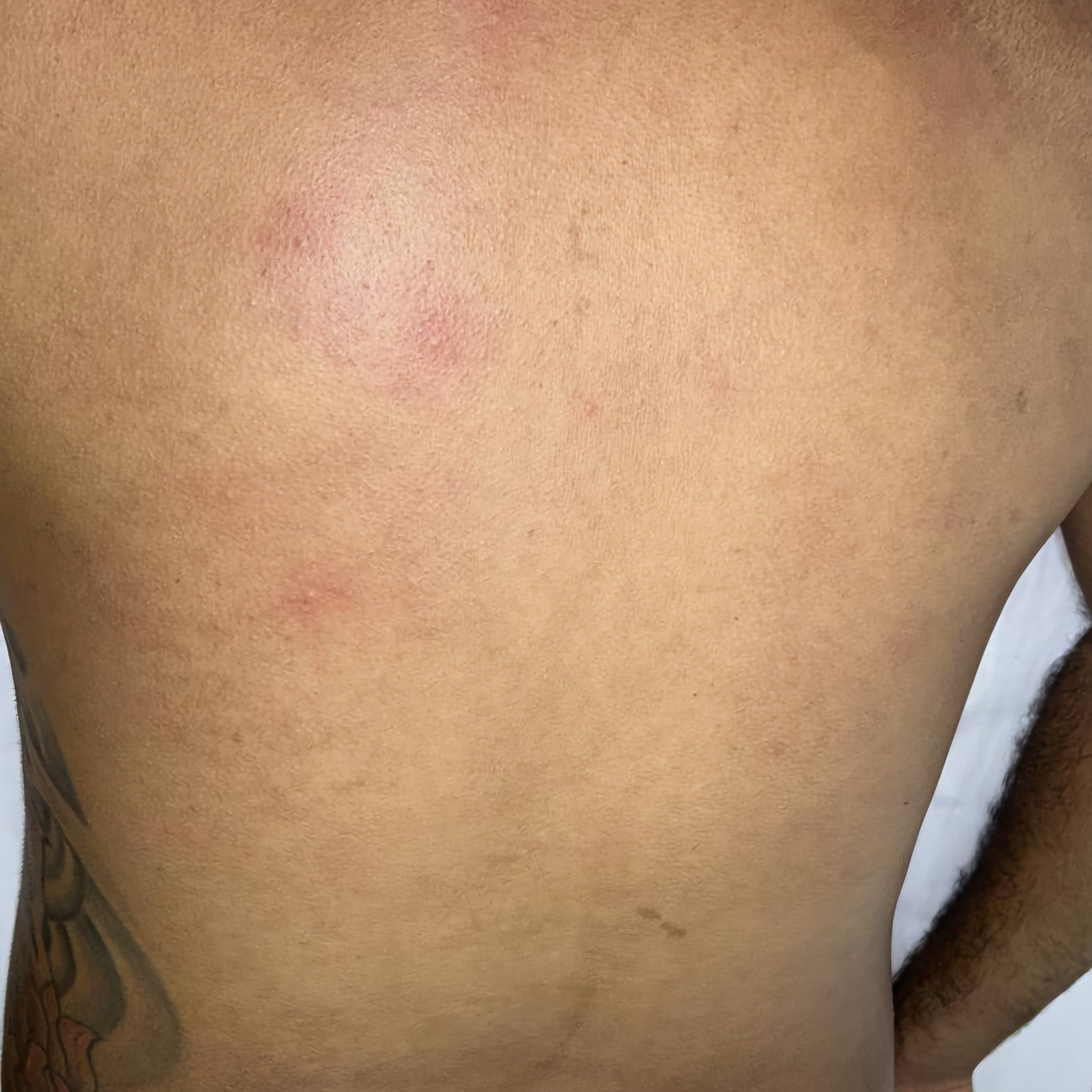 Epilação MAS. Costas