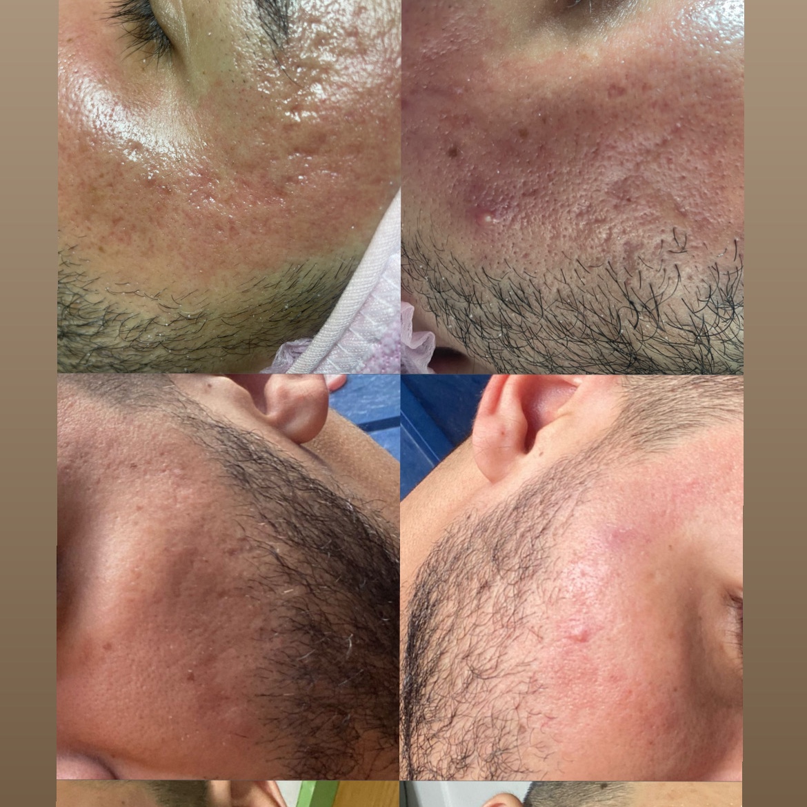 microagulhamento facial