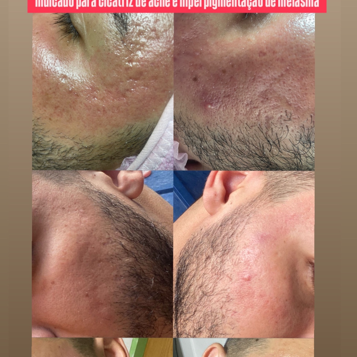 microagulhamento facial PACOTE