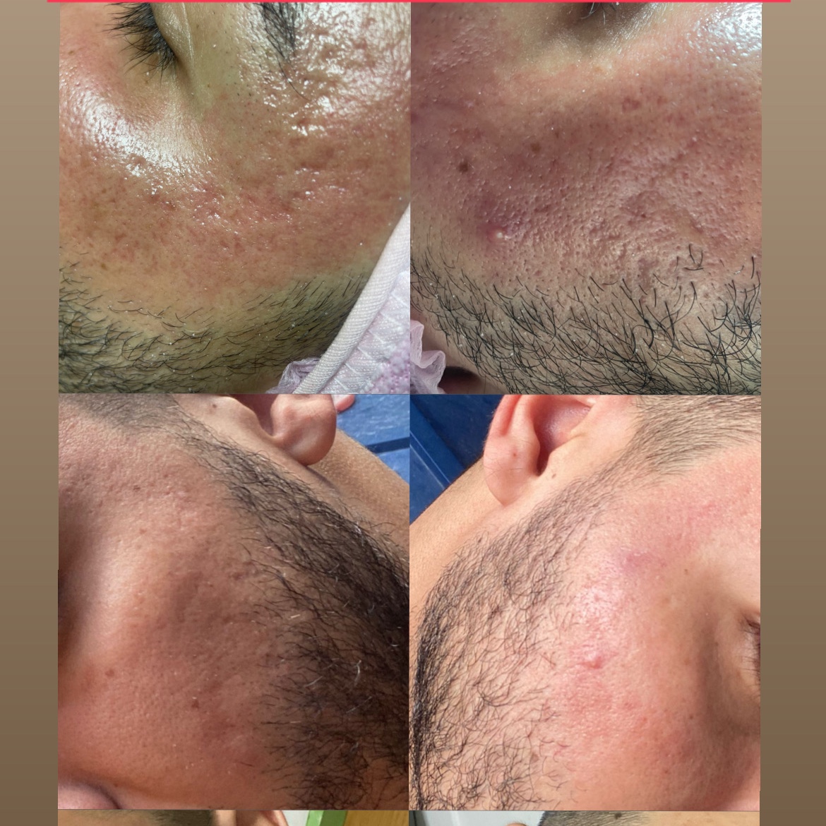 peeling de diamante + microagulhamento facial