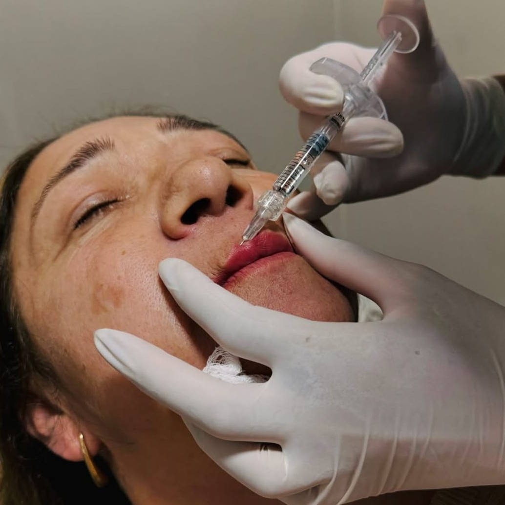 Preenchimento labial