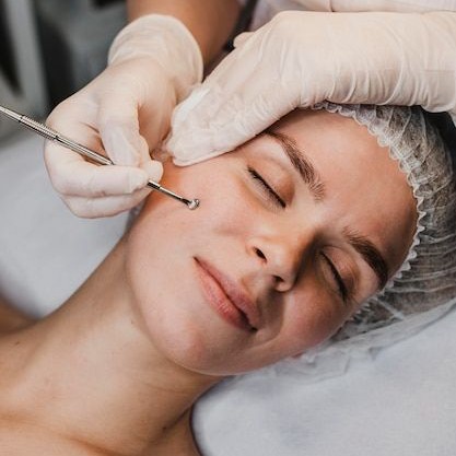 Limpeza de pele com peeling de diamante