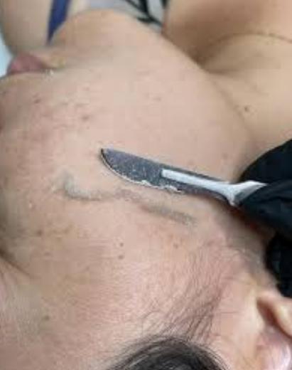 Limpeza de pele + dermaplaning