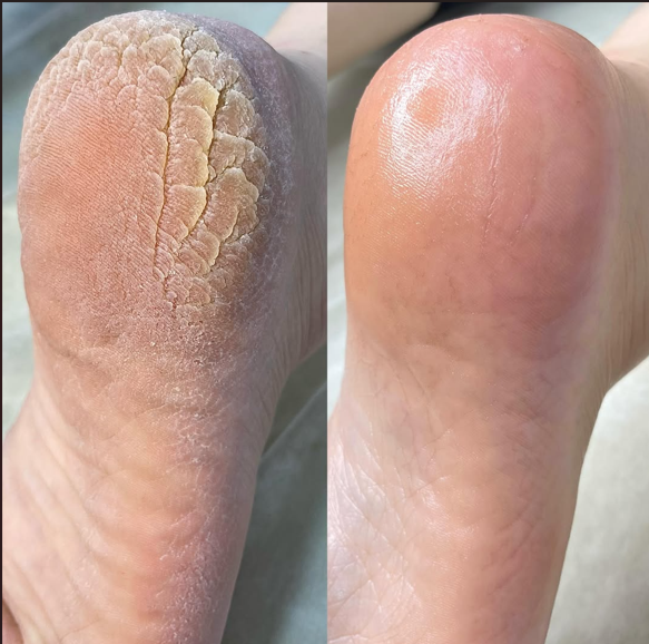 Limpeza de pele + spa dos pes (promo)