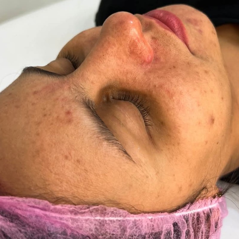 Limpeza de Pele Profunda