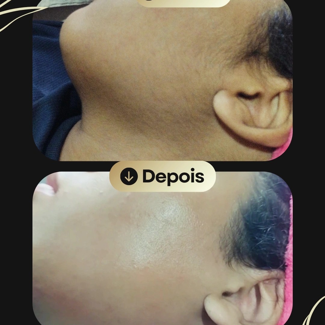 Dermaplaning