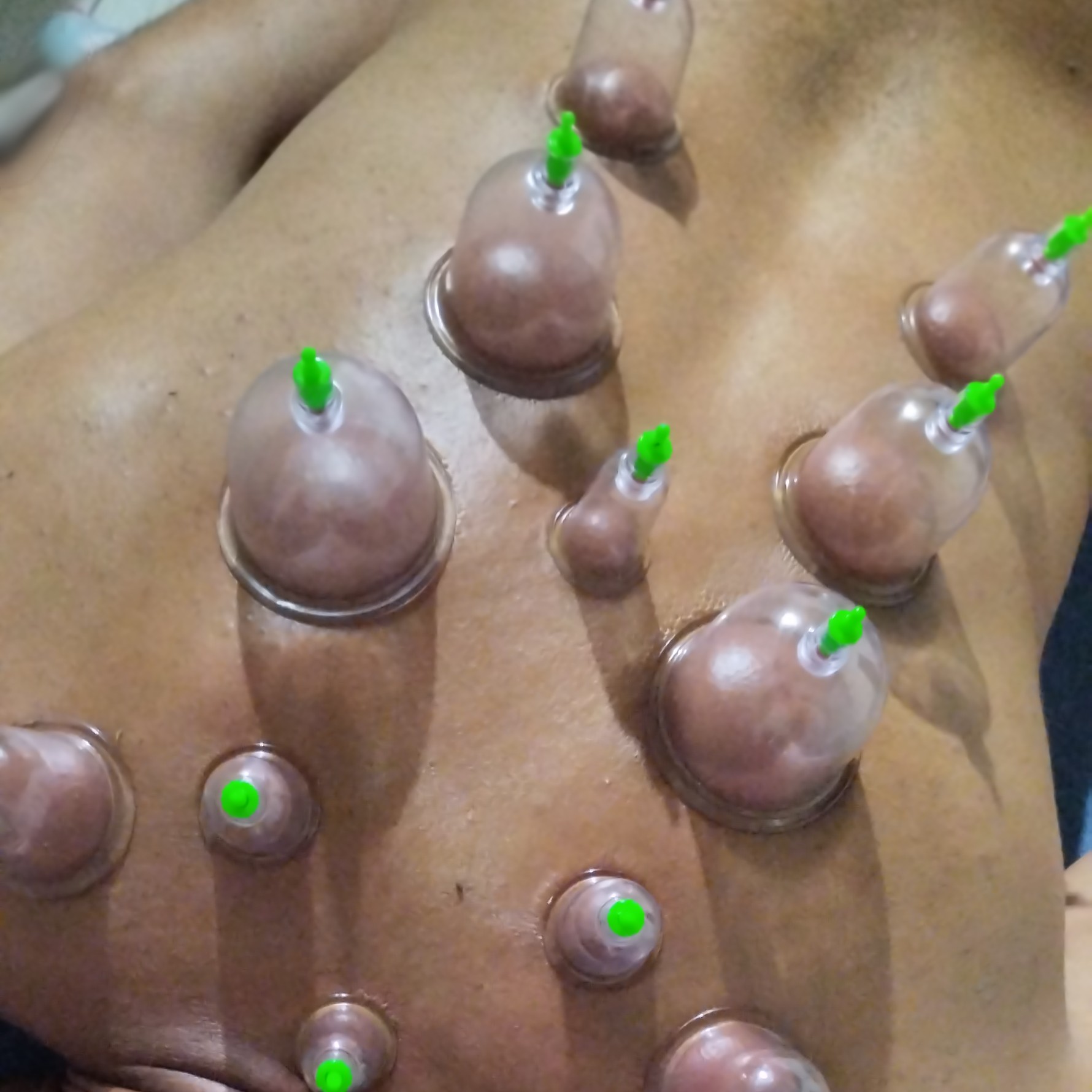 Ventosaterapia