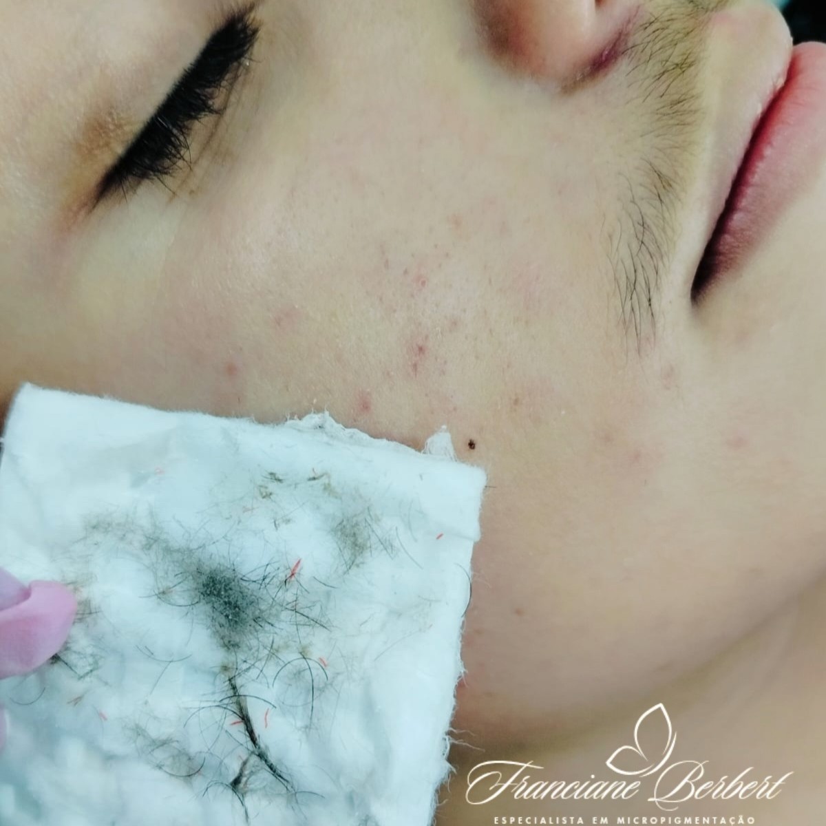 Dermaplanning facial