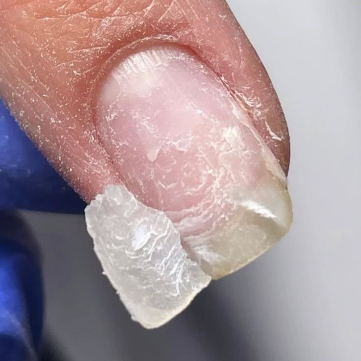 unhas fracas/quebradiças/retirada incorreta do gel