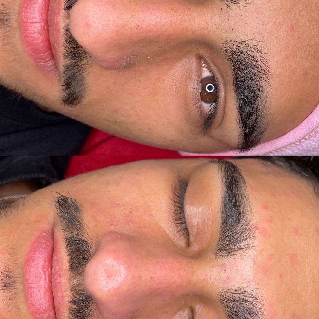 Limpeza de Pele